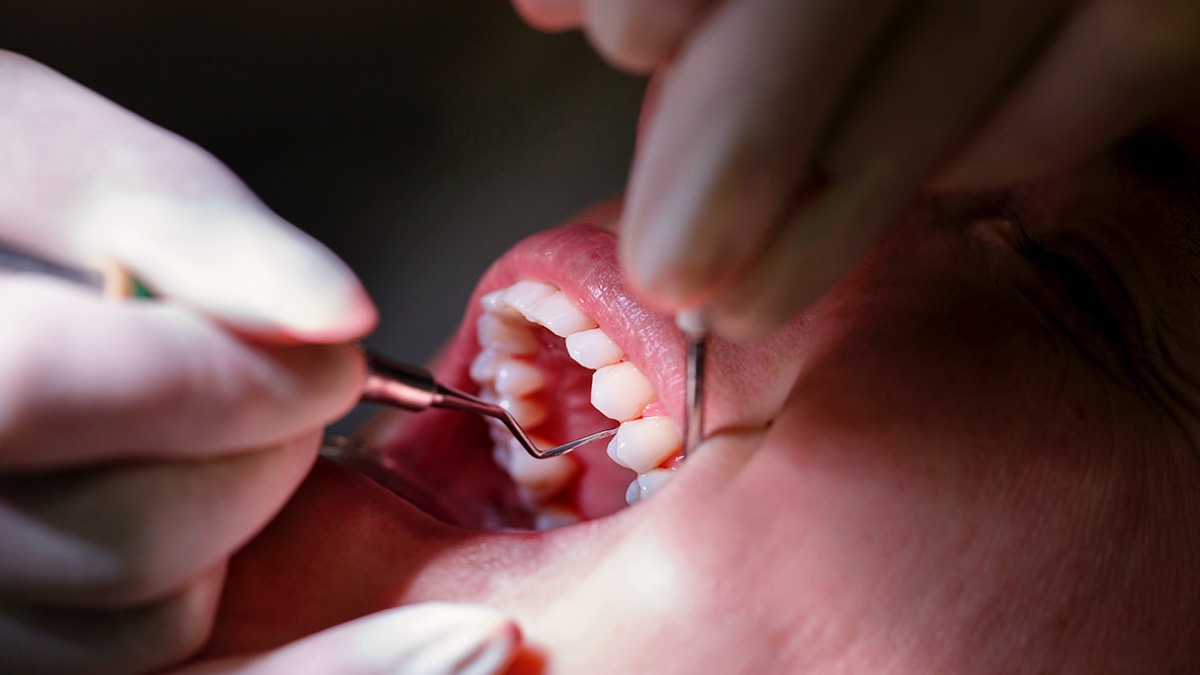 tratamento periodontite