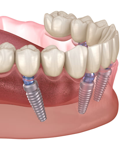 implante dentário rota arte