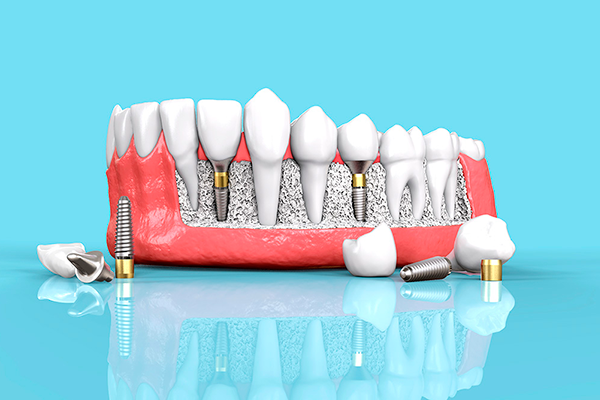 prótese fixa ou implante dentário